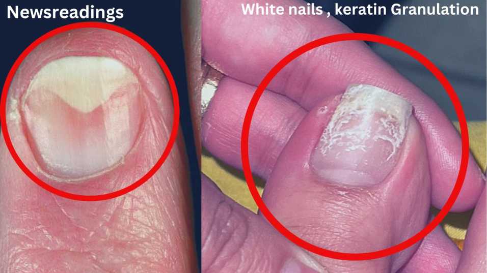 Symptoms and Diagnosis of Keratin Granulation